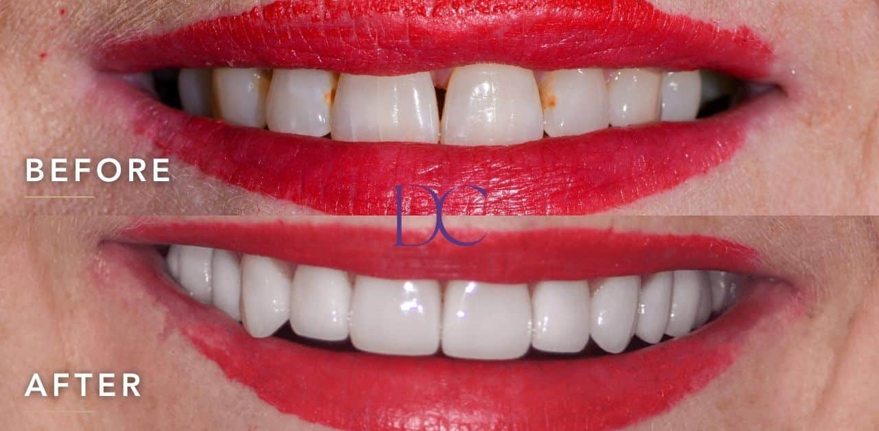 Cynthia-Dental-Implants-and-Porcelain-Veneers-Journey-in-Sunbury-Dental-Couture