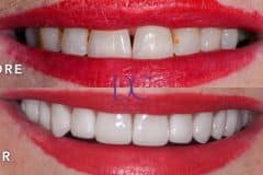 Cynthia-Dental-Implants-and-Porcelain-Veneers-Journey-in-Sunbury-Dental-Couture