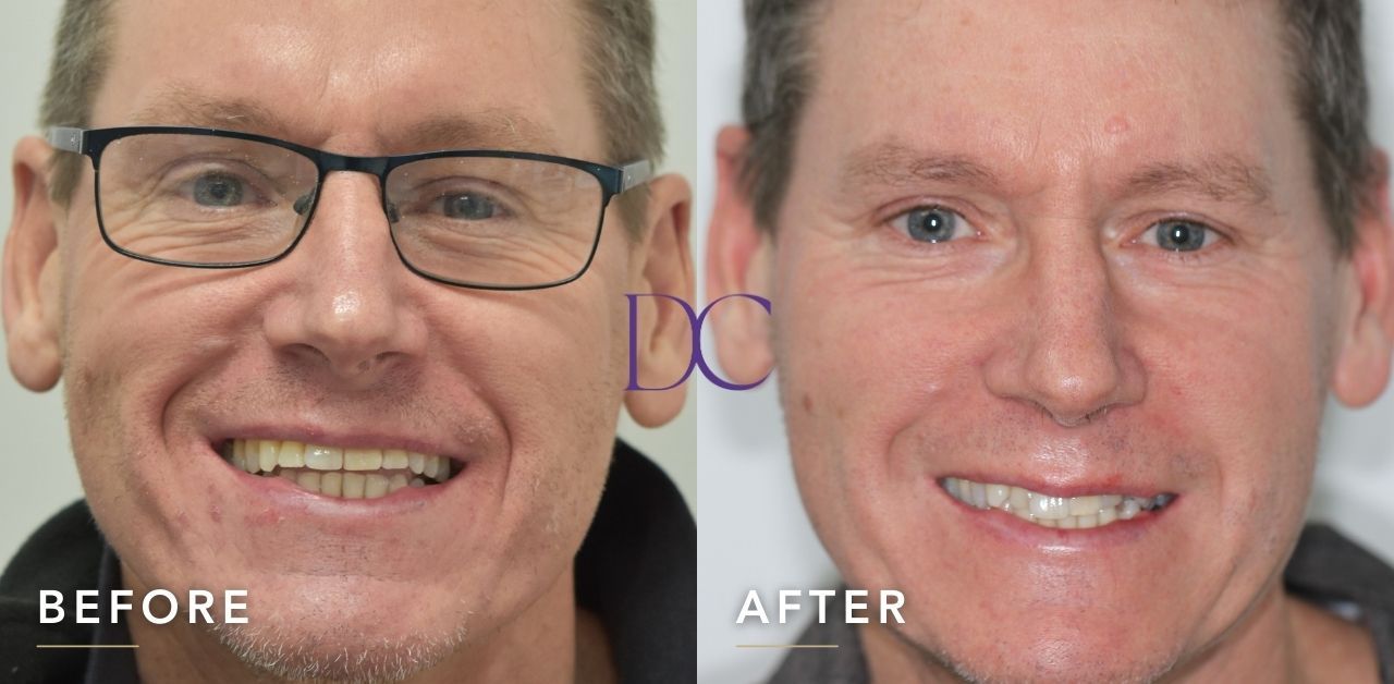 Ian-Invisalign-Treatment-in-Bacchus-Marsh-Dental-Couture