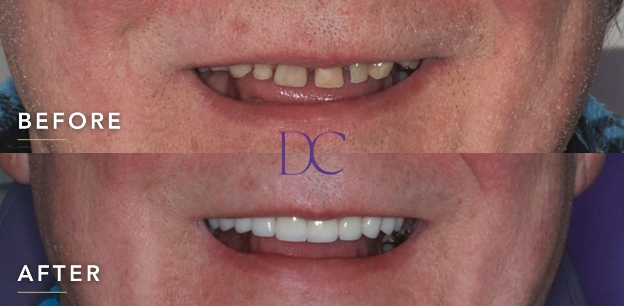 JL-Dental-Implant-and-Porcelain-Crowns-in-Sunbury-Dental-Couture