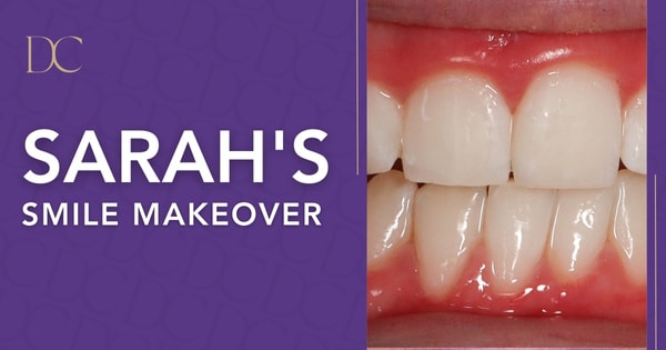 Sarah’s Zoom Whitening Treatment in Melbourne