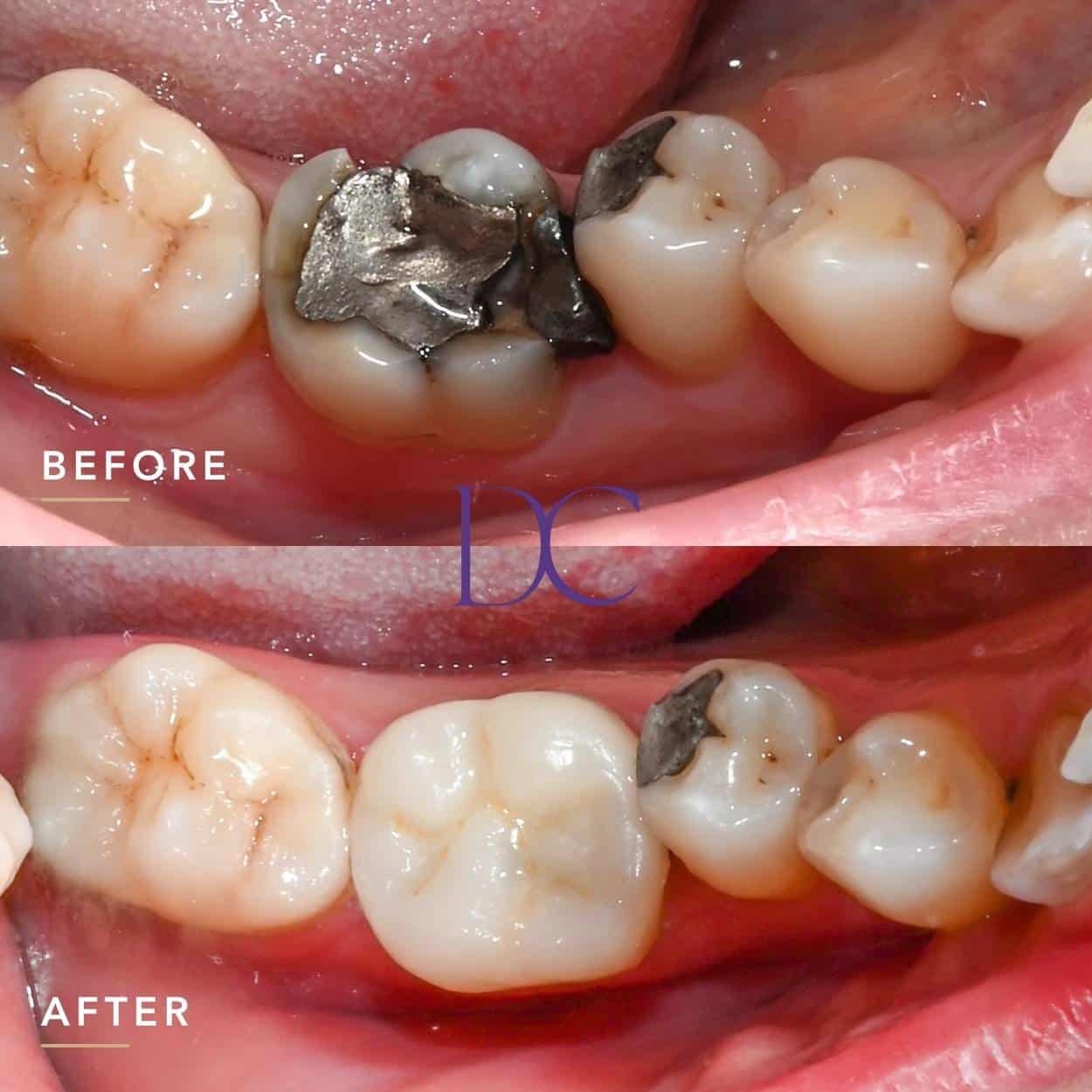 Jess’ Same-day Porcelain Crown Journey in Melbourne North West At Dental Couture