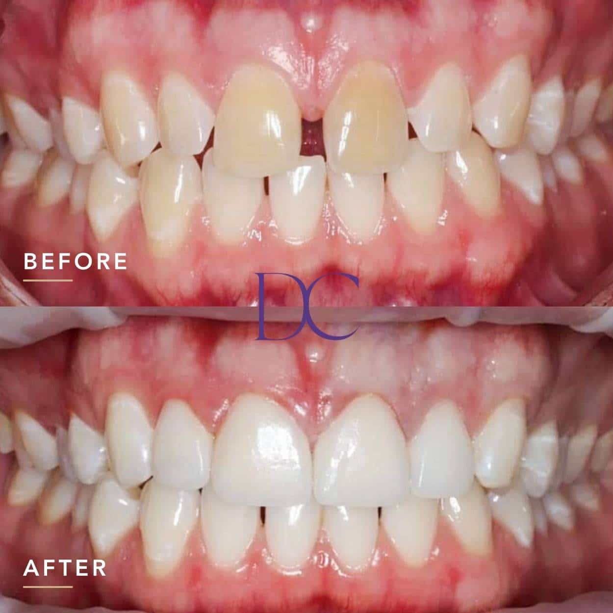 Josh’s Porcelain Veneers Journey in Melbourne North West At Dental Couture