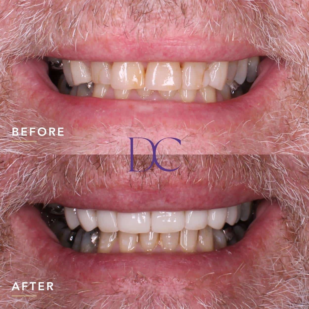 Porcelain Veneers Journey nearby Melbourne North West At Dental Couture