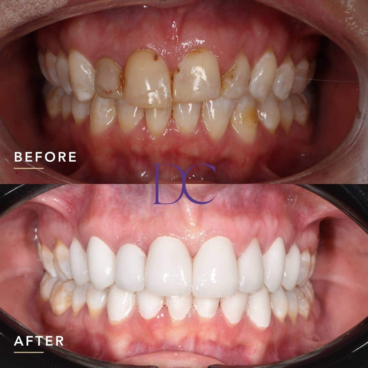 Smile Makeover in Melbourne North West At Dental Couture