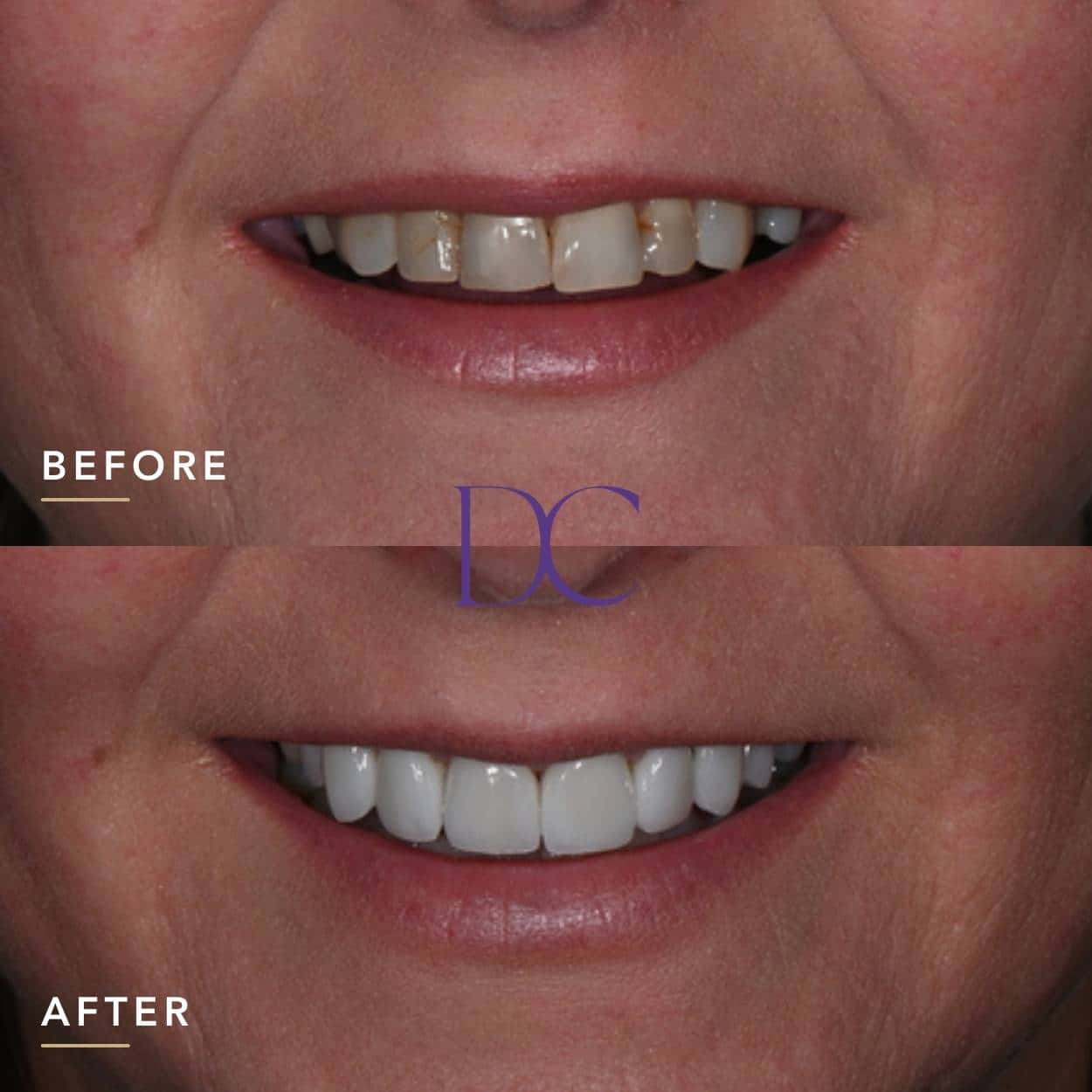 Zoe’s Smile Makeover in Melbourne North West At Dental Couture