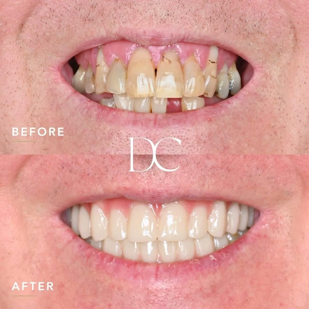 Arthur of Sunbury's AO4 Smile Journey in_Dental Couture