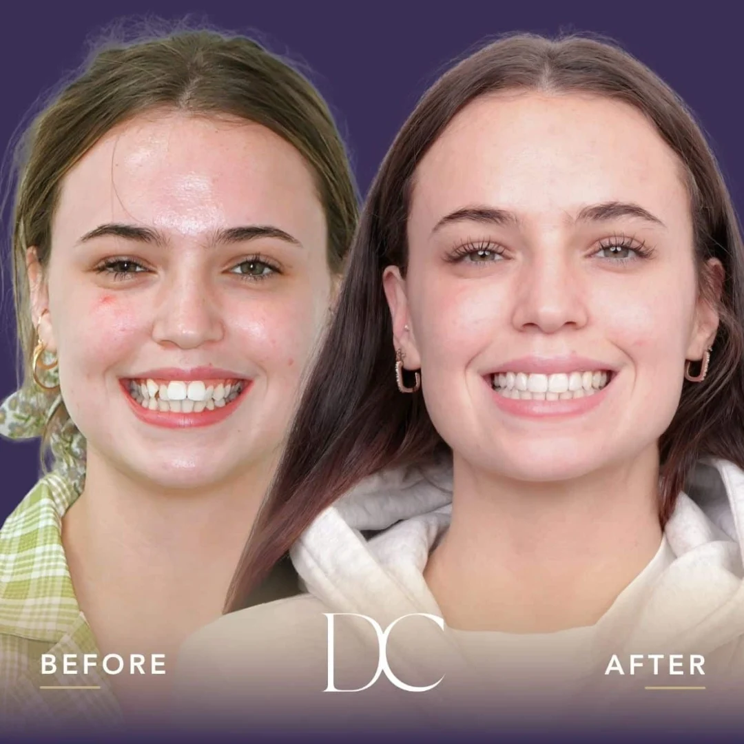 Breeana of Sunbury's Invisalign Journey in Dental Couture