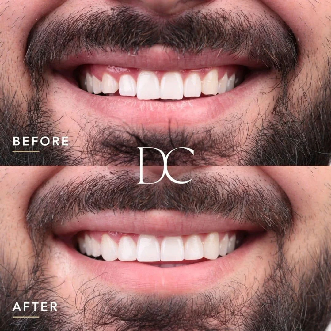 Carlos of Broadmeadows's Composite Bonding and Gum Laser Journey in Dental Couture