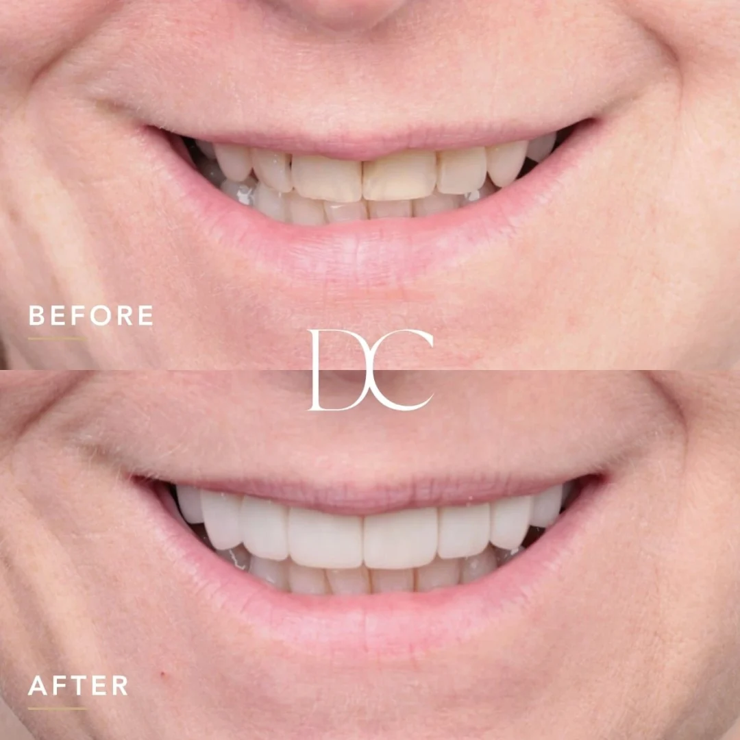Colleen of Sunbury's Porcelain Veneers and Crown Journey at Dental Couture