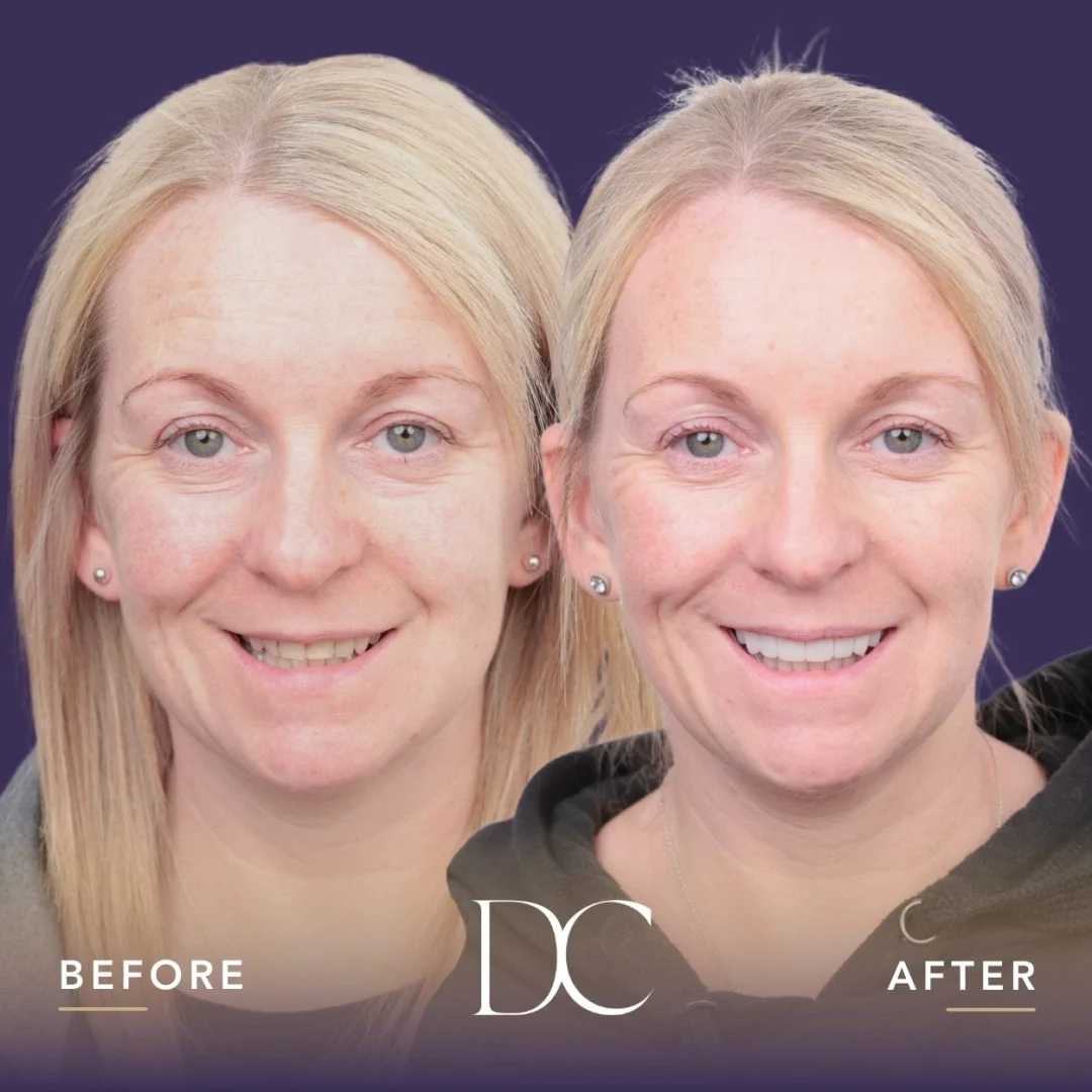Colleen of Sunbury's Porcelain Veneers and Crown Journey in Dental Couture