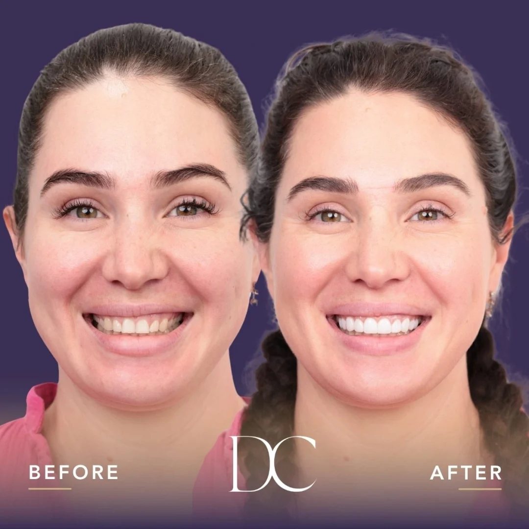 Coral of Sunbury's Hybrid No-Prep Veneers Journey in Dental Couture