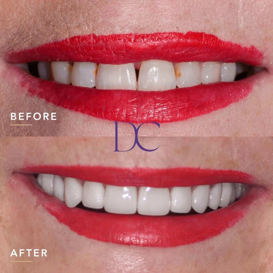 Cynthia’s Dental Implants and Porcelain Veneers Journey in Melbourne North West At Dental Couture