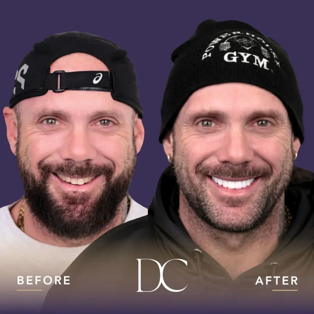 Before and after smile transformation at Dental Couture in Australia.