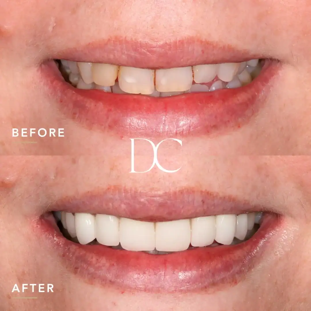 Before and after smile transformation at Dental Couture in Australia.