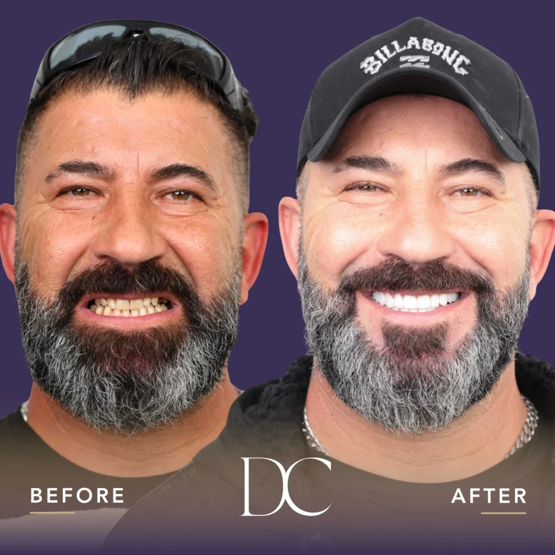Dental Crown, Implants & Veneers