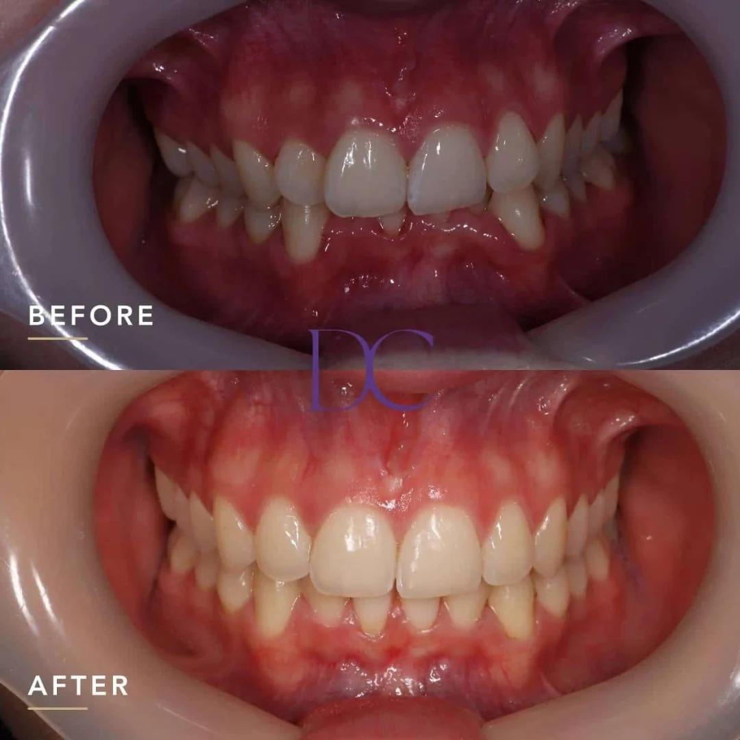 Eden's Smile Makeover Journey in Melbourne North West At Dental Couture