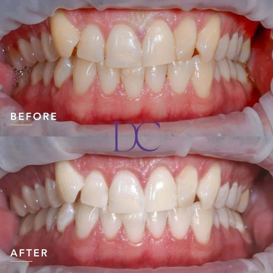 Elsa’s Zoom Whitening Journey in Melbourne North West At Dental Couture