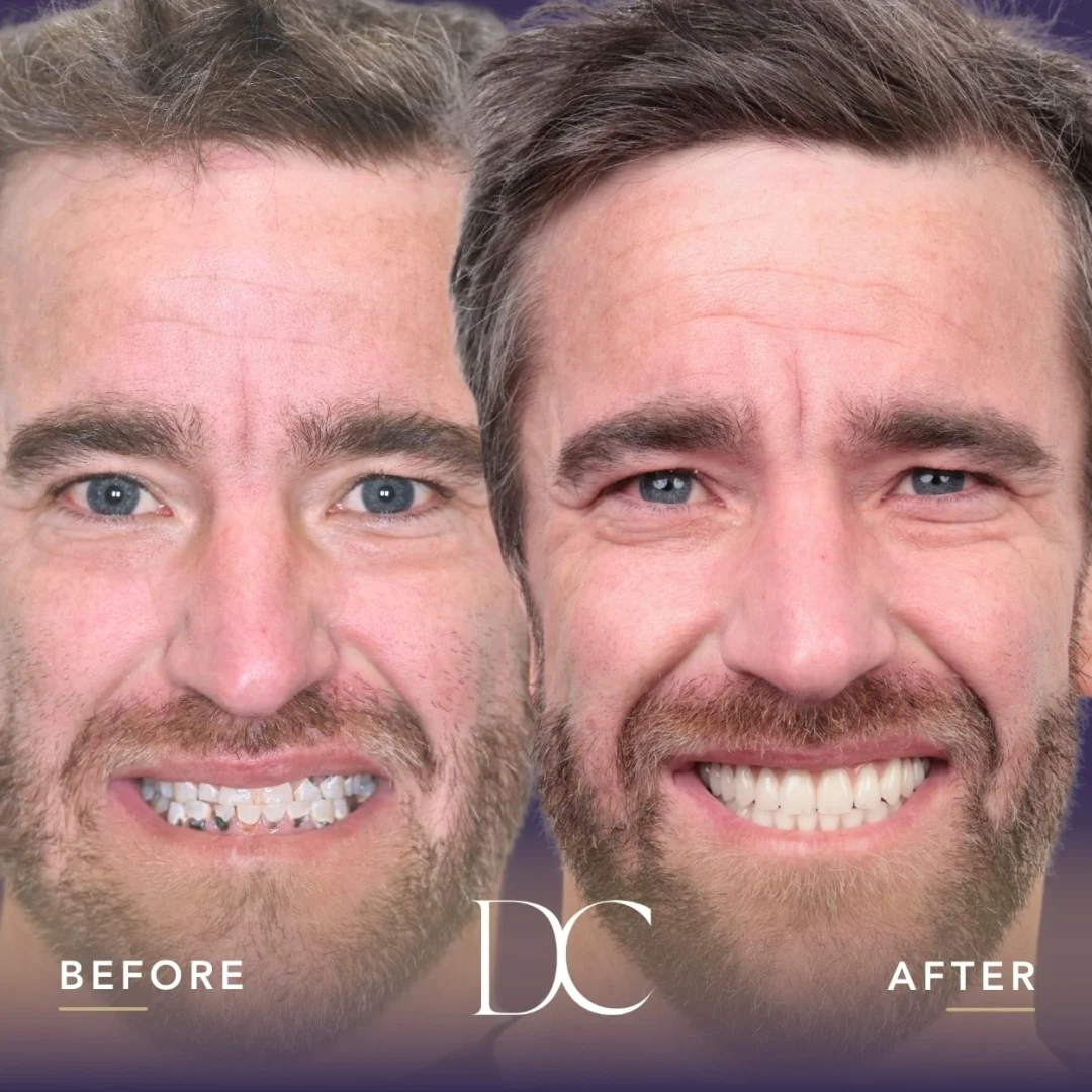 Gavin Of Melbourne North West's All-On-4 Journey In Dental House