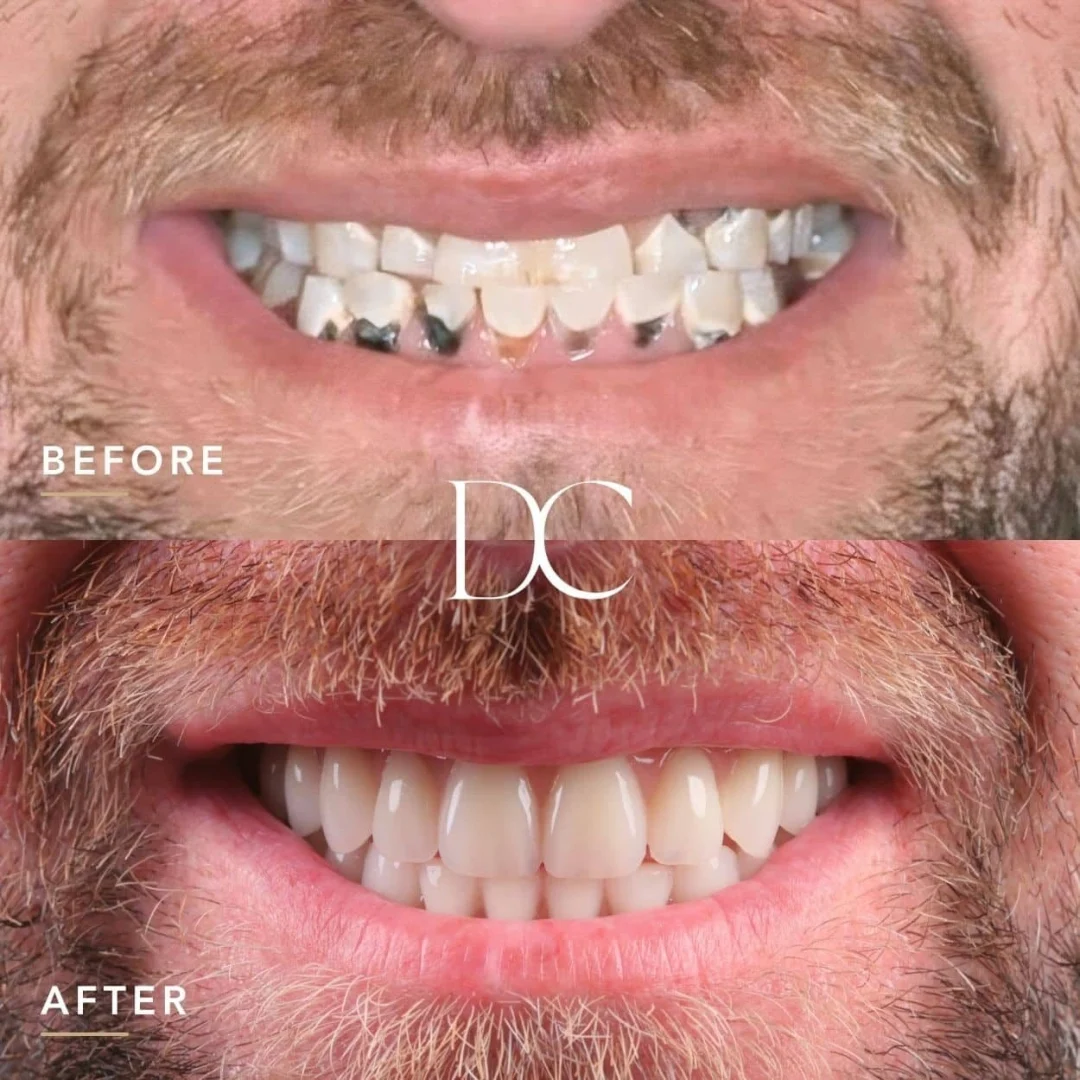 Gavin of Melbourne's AO4 Smile Journey in_Dental Couture