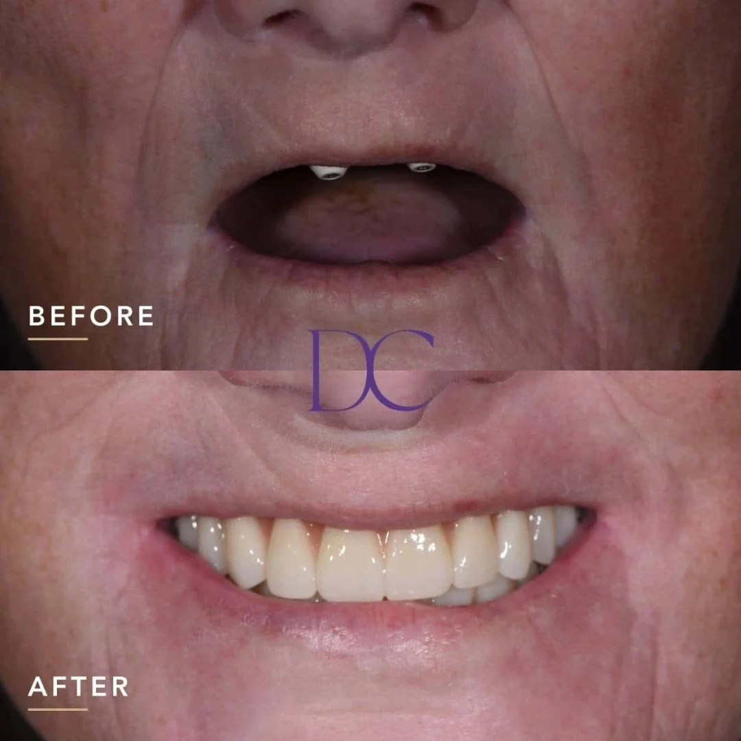 Gayle's All-On-4 Implants Journey in Melbourne North West At Dental Couture