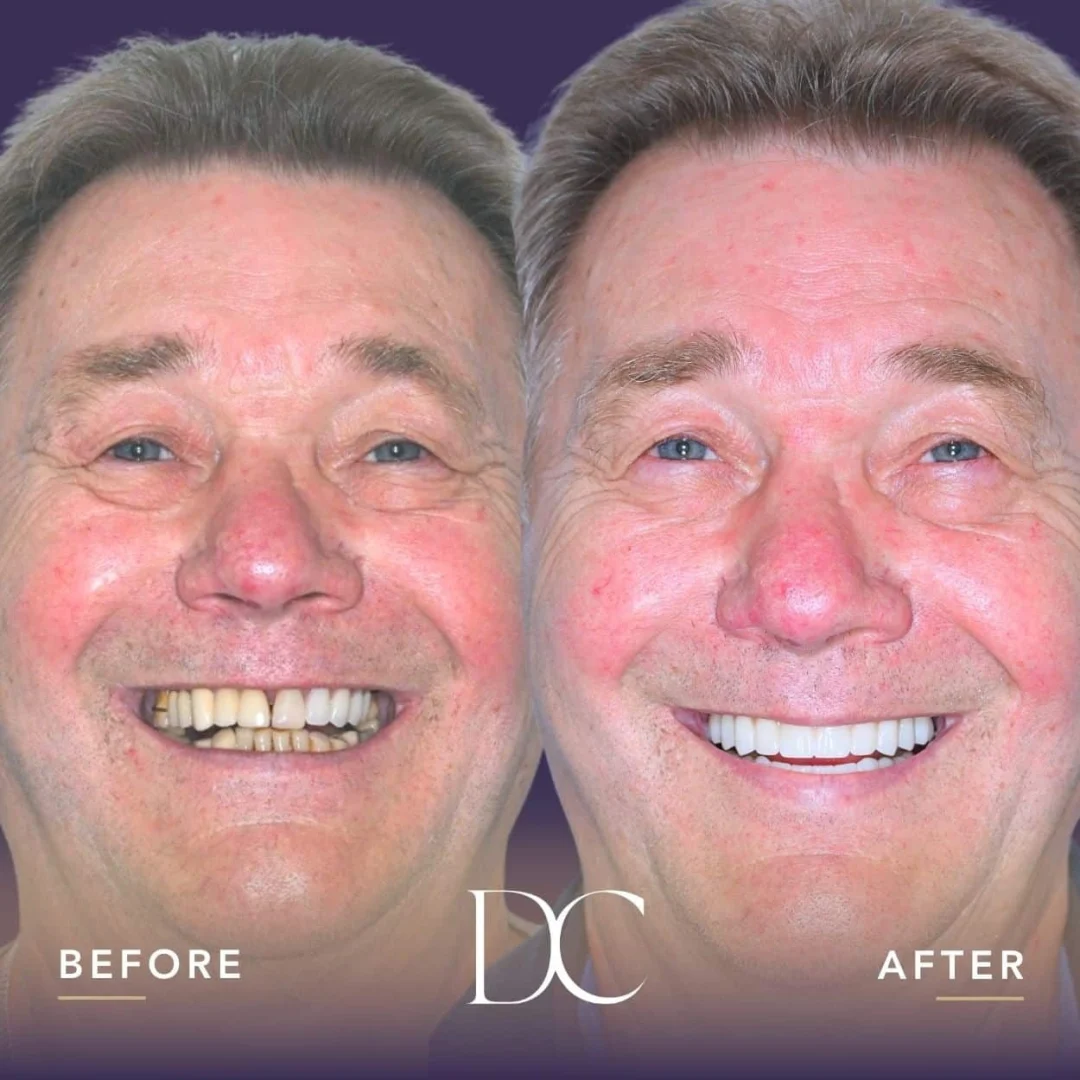 George of Riddells Creek's AO4 Smile Journey in Dental Couture