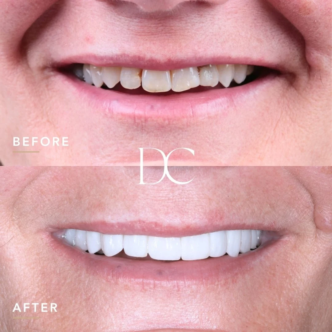 Grace Of Melbourne North West's Veneers and Invisalign Journey In Dental House