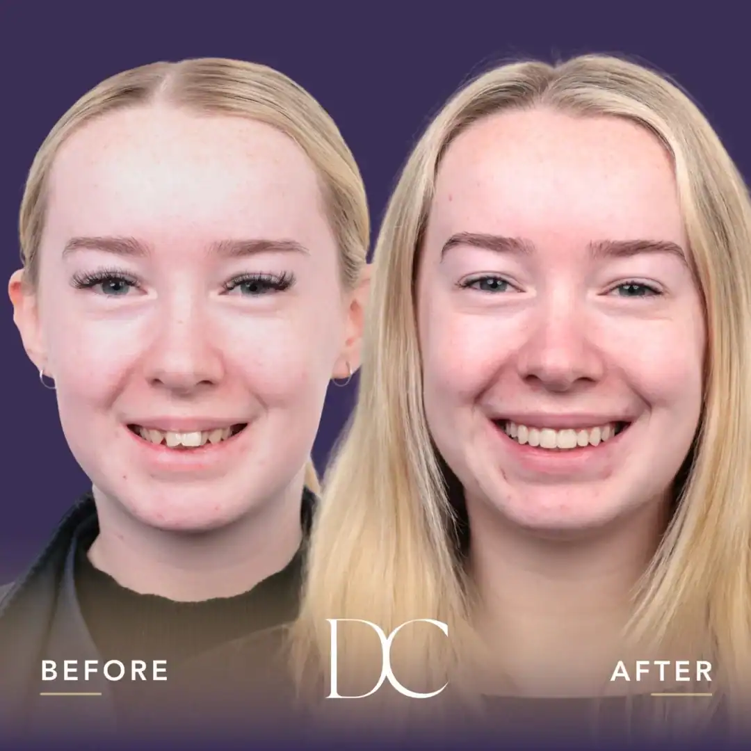 Before and after dental makeover showing improved smile and teeth alignment.