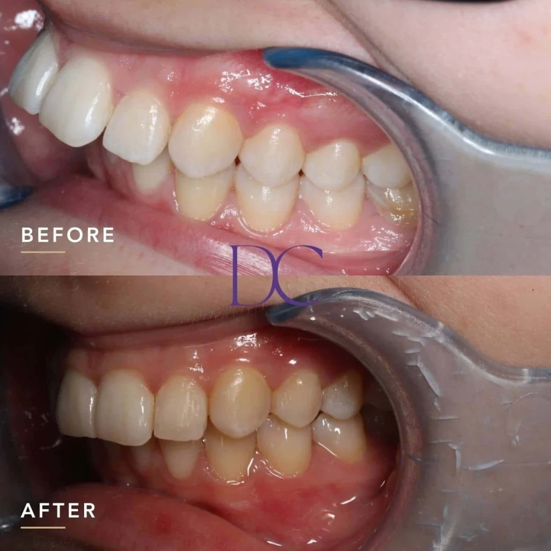 Invisalign Journey in Melbourne North West At Dental Couture