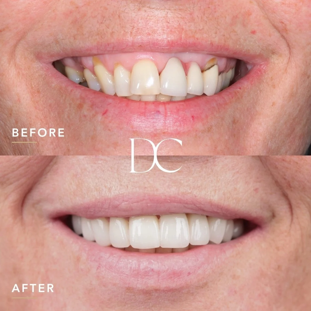 Jane of Melbourne's Dental Veneers Journey in Dental Couture