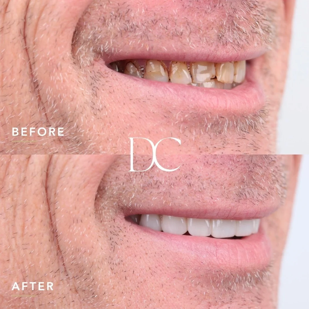 Jed of Diggers Rest's Porcelain Veneers Journey at Dental Couture