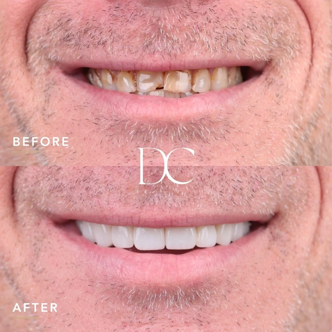 Jed of Diggers Rest's Porcelain Veneers Journey in Dental Couture