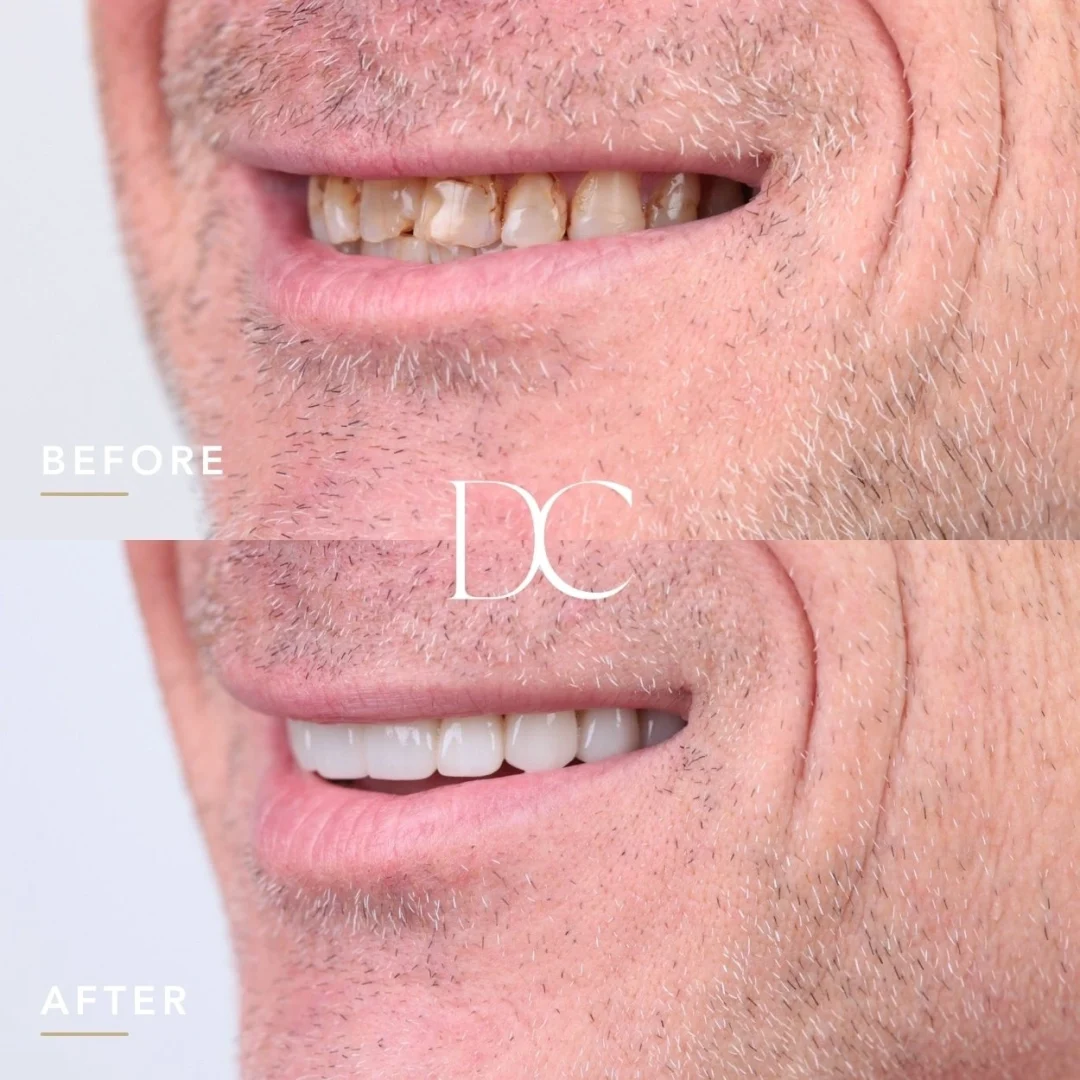 Jed of Diggers Rest's Porcelain Veneers Journey near Dental Couture
