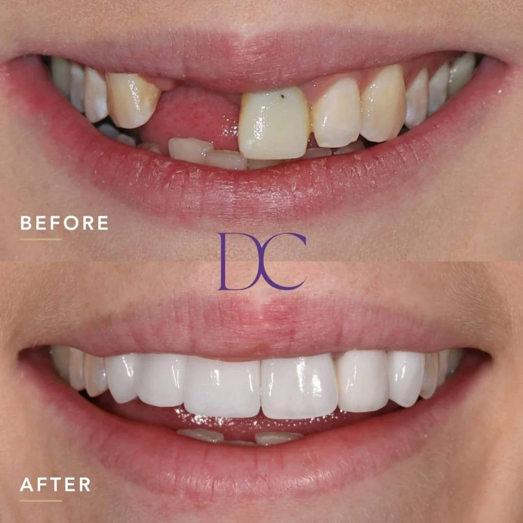 Jessica’s Dental Implant and Porcelain Crowns in Melbourne North West At Dental Couture