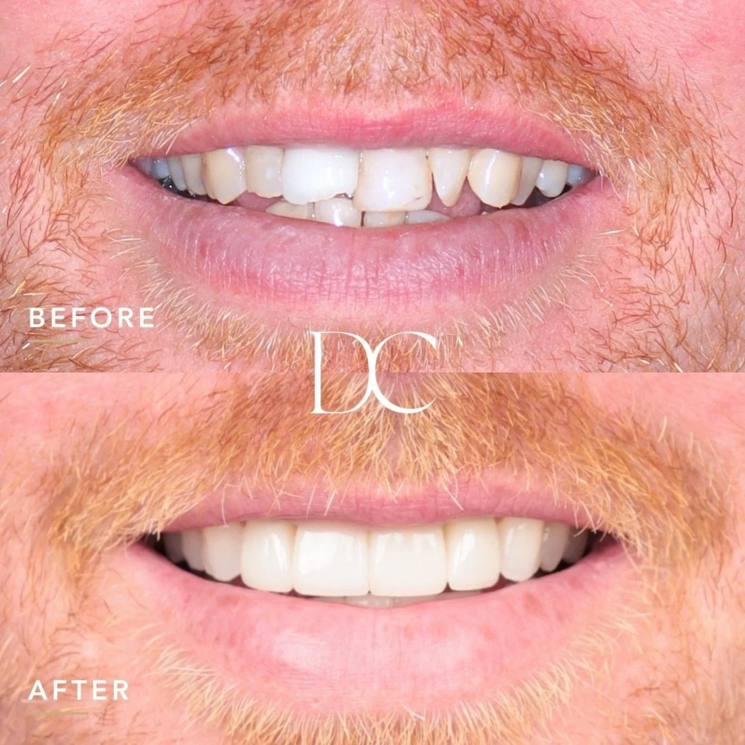 John Of Melbourne North West's Teeth Whitening, Veneers and Invisalign Journey In Dental House after 8-12 months