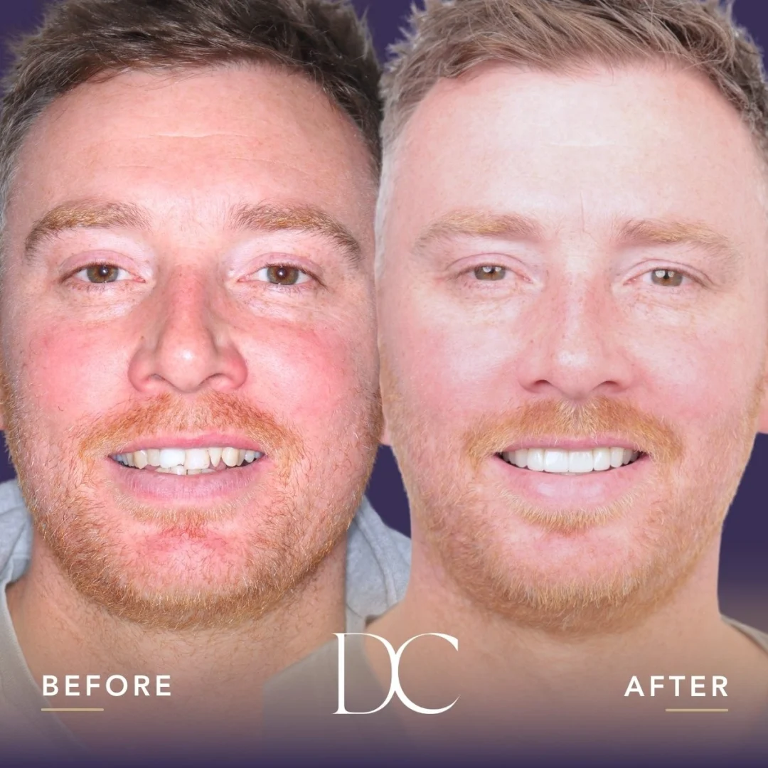 John Of Melbourne North West's Teeth Whitening, Veneers and Invisalign Journey In Dental House