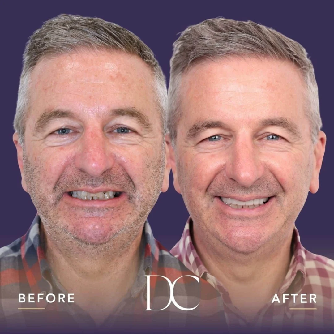John of Sunbury's Dental Crown Journey in Dental Couture