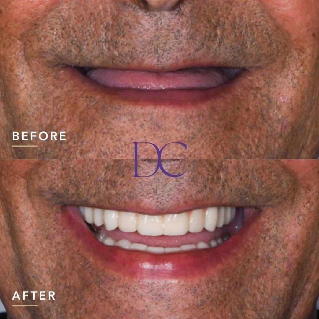John’s Dental Implant Journey in Melbourne North West At Dental Couture