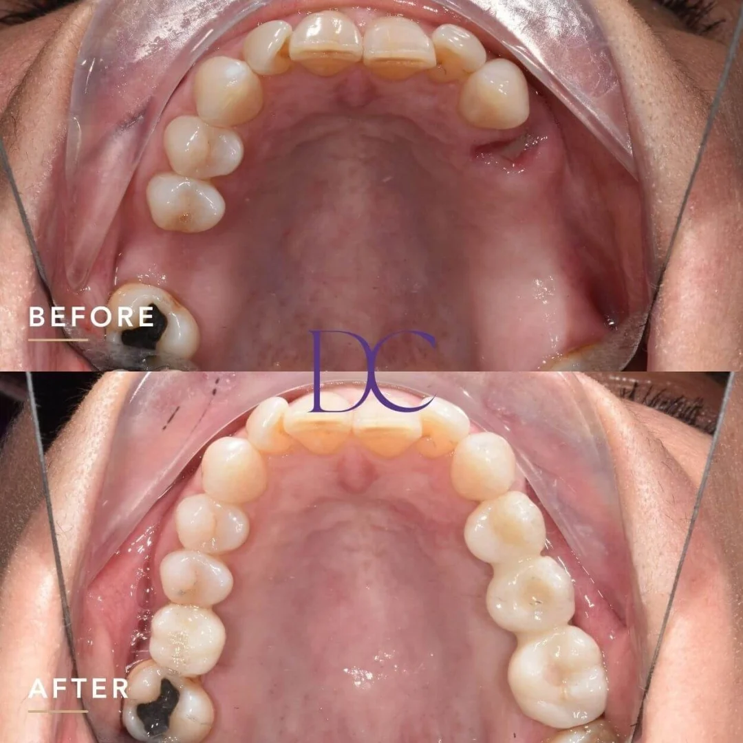 Jo's Dental Implants Journey in Melbourne North West At Dental Couture