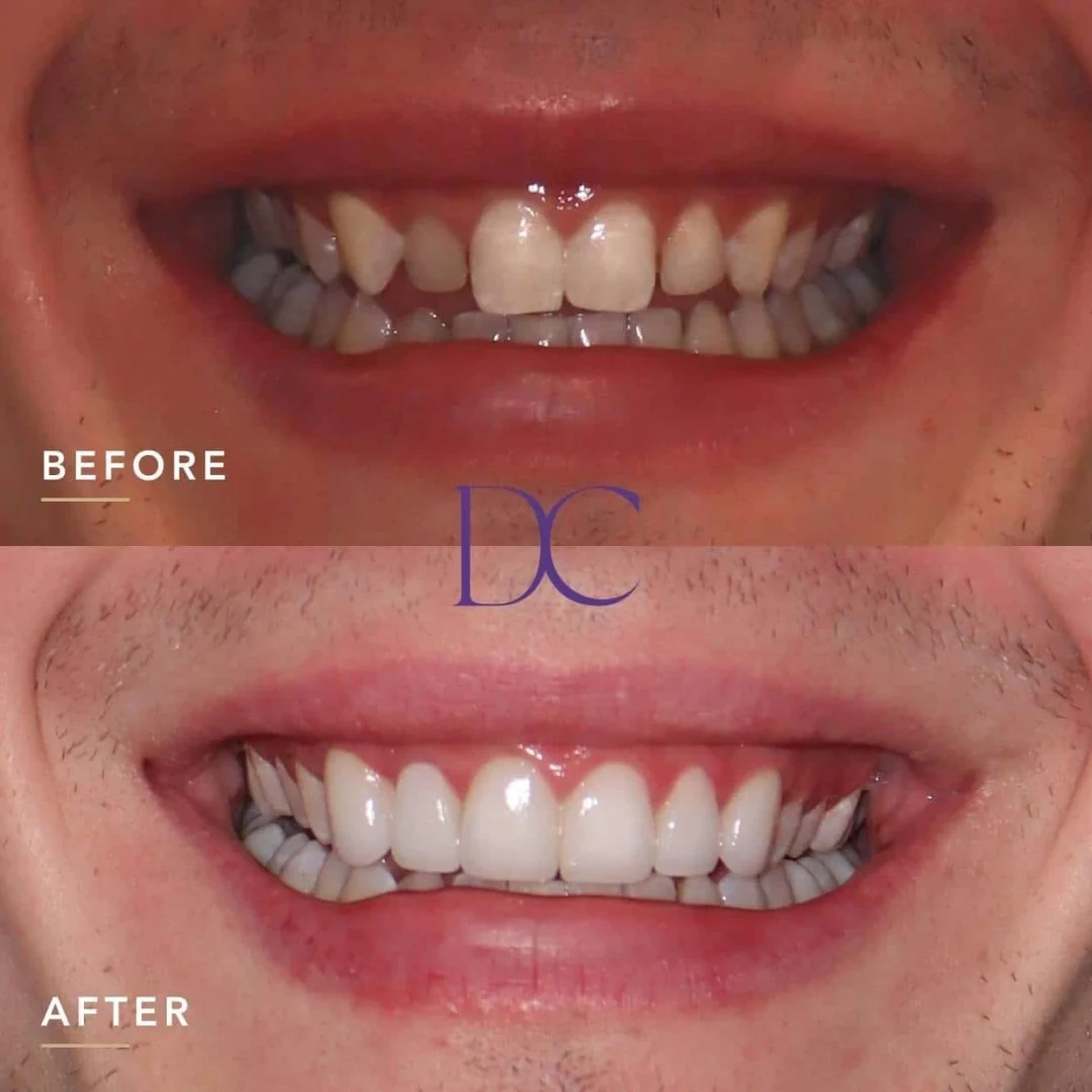 Kane Clark's Porcelain Veneers Journey in Melbourne North West At Dental Couture