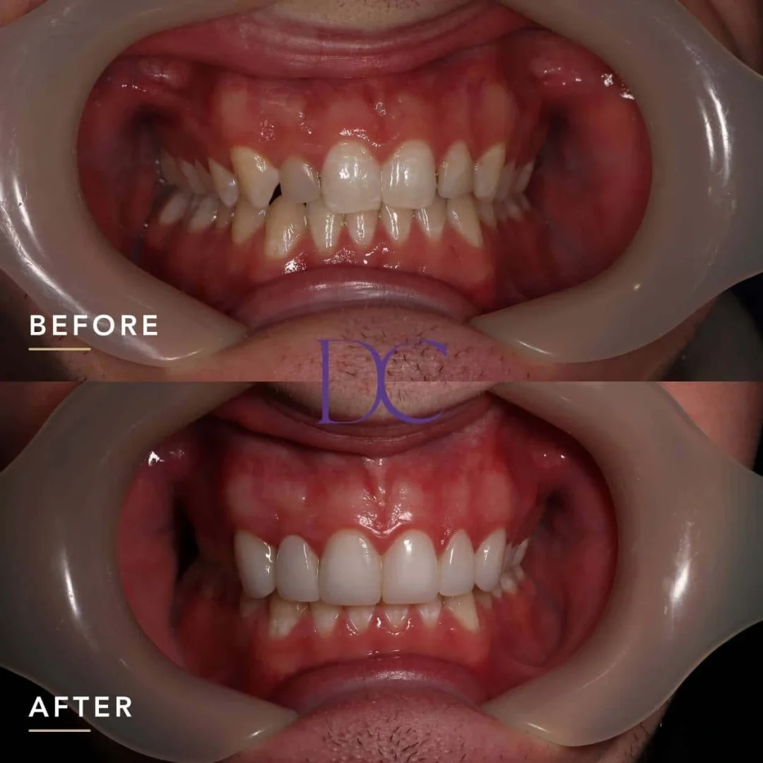 Kane C's Porcelain Veneers Journey in Melbourne North West At Dental Couture