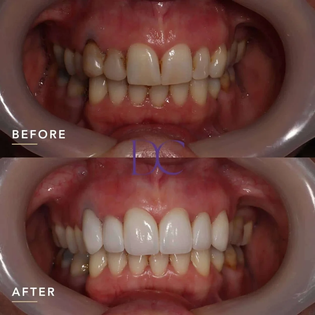Karyn's Porcelain Crowns Veneers Journey in Melbourne North West At Dental Couture