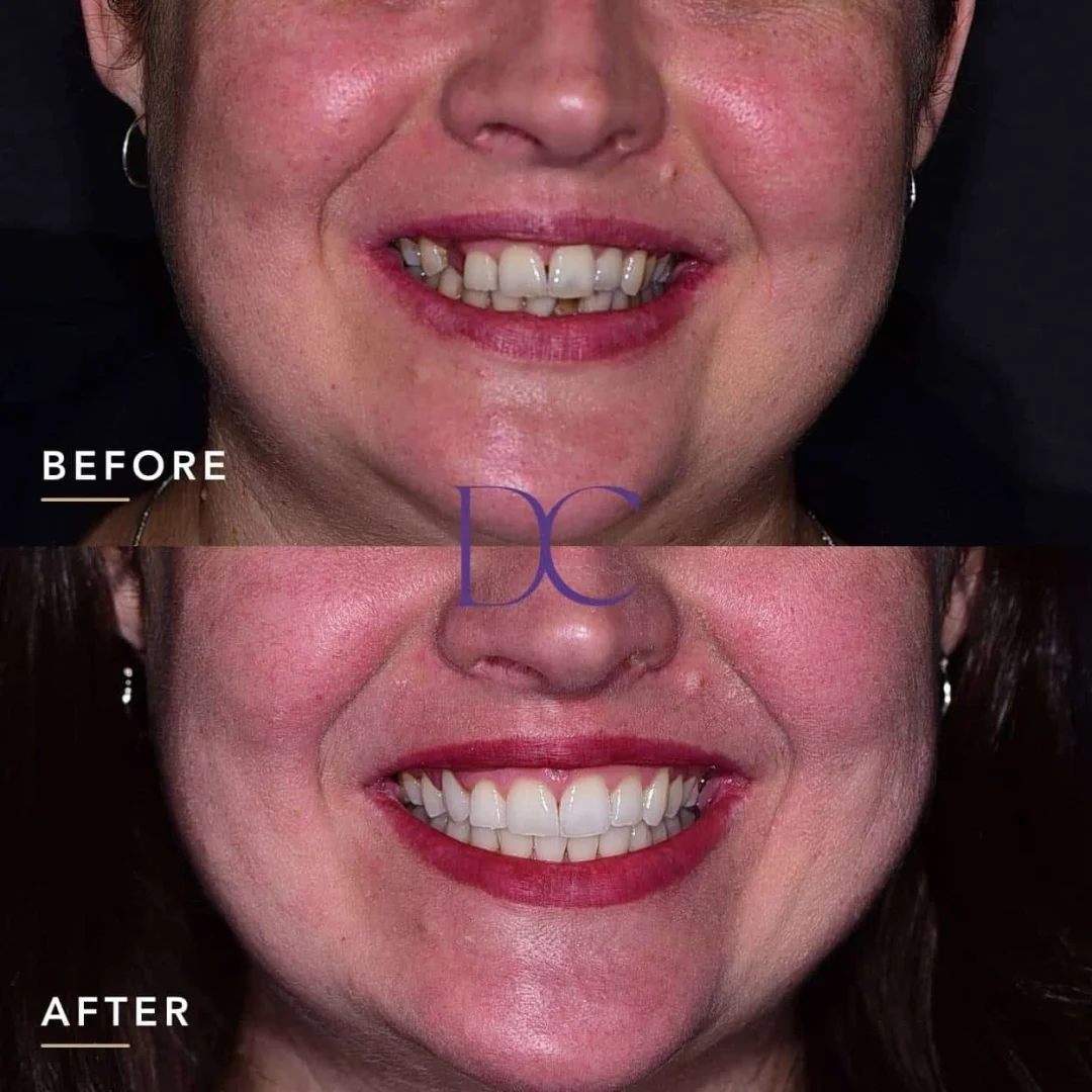 Katherine’s Invisalign, Implant and Whitening in Melbourne North West At Dental Couture