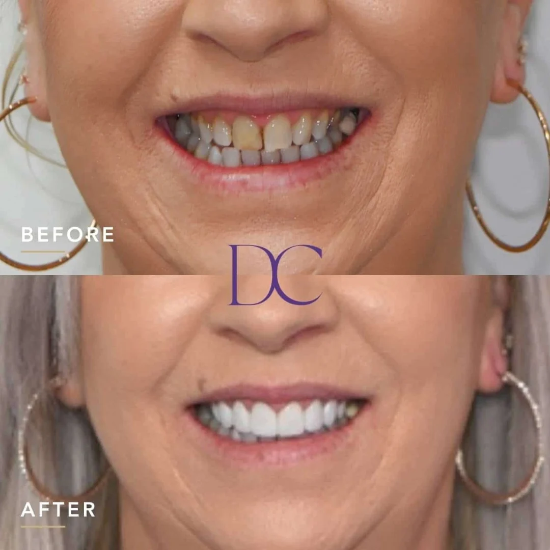 Linda’s Smile Makeover in Melbourne North West At Dental Couture