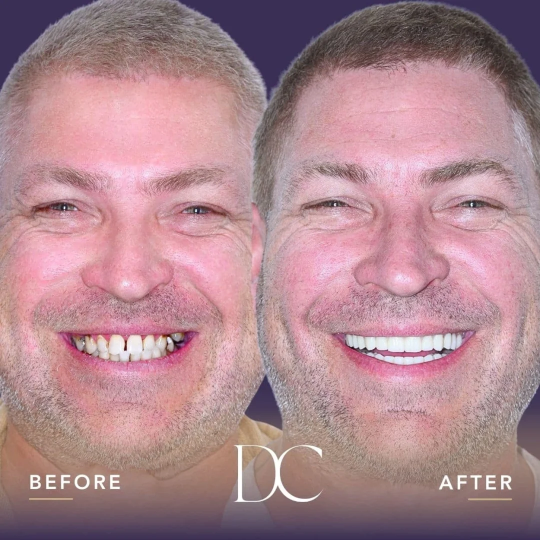 Luke of Gisborne's A04 Smile Journey in Dental Couture