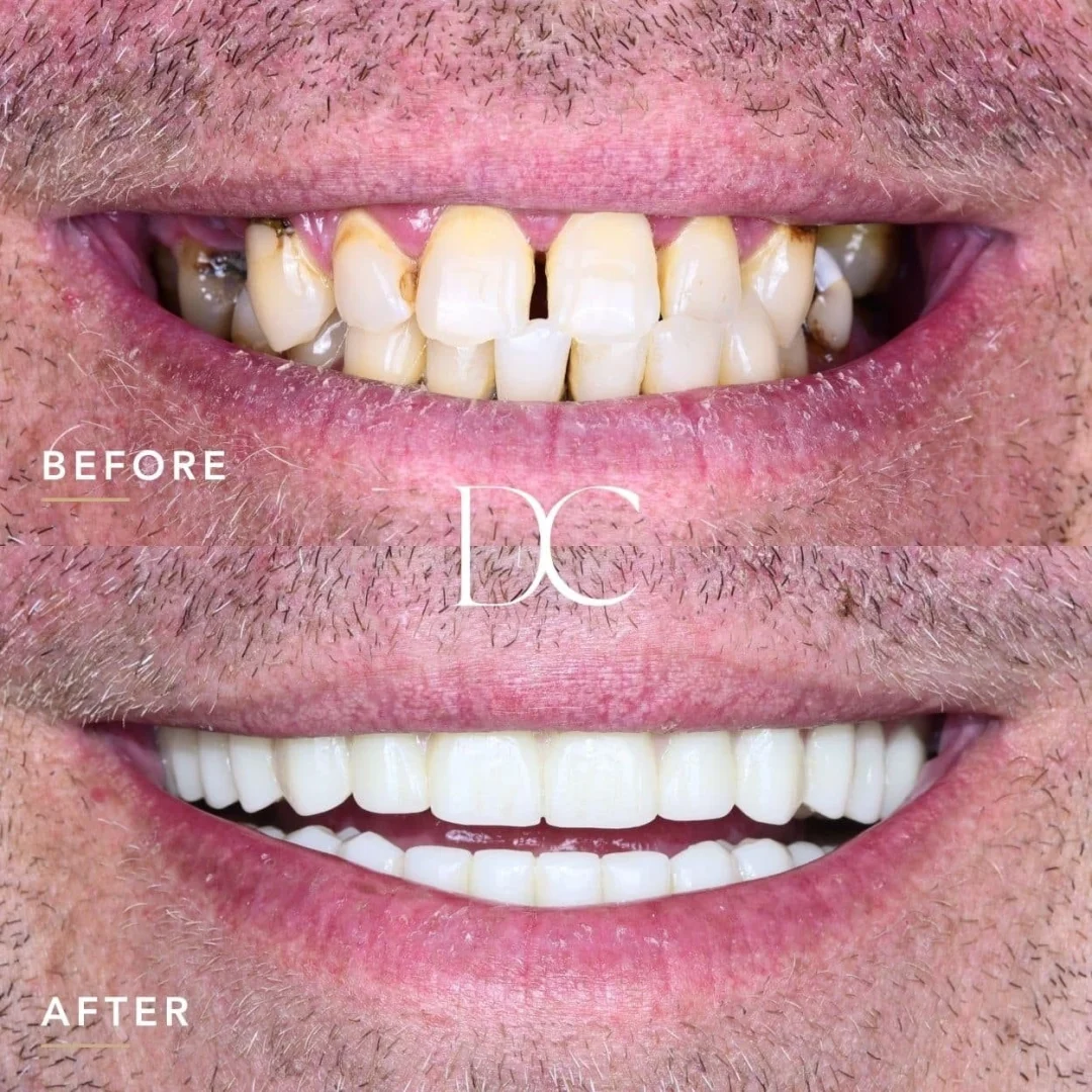 Luke of Gisborne's A04 Smile Journey in_Dental Couture
