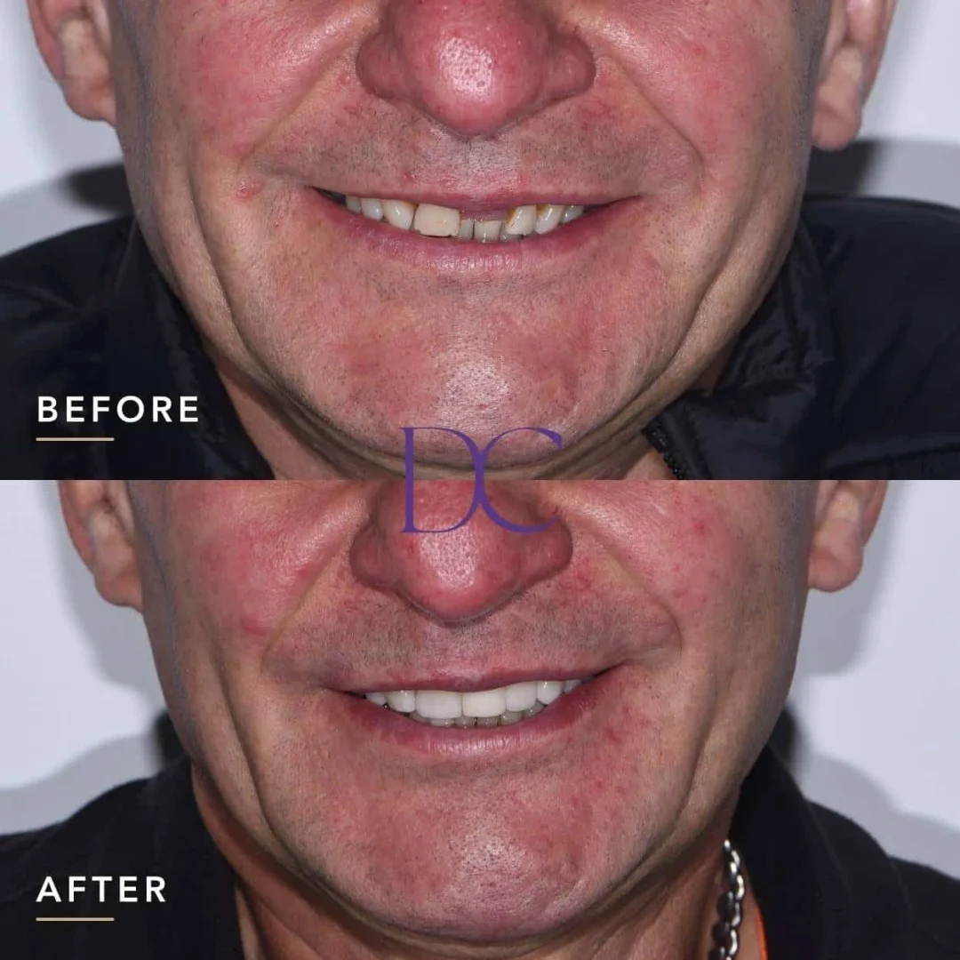 Marek's Dental Veneers and Dental Implants Journey in Melbourne North West At Dental Couture