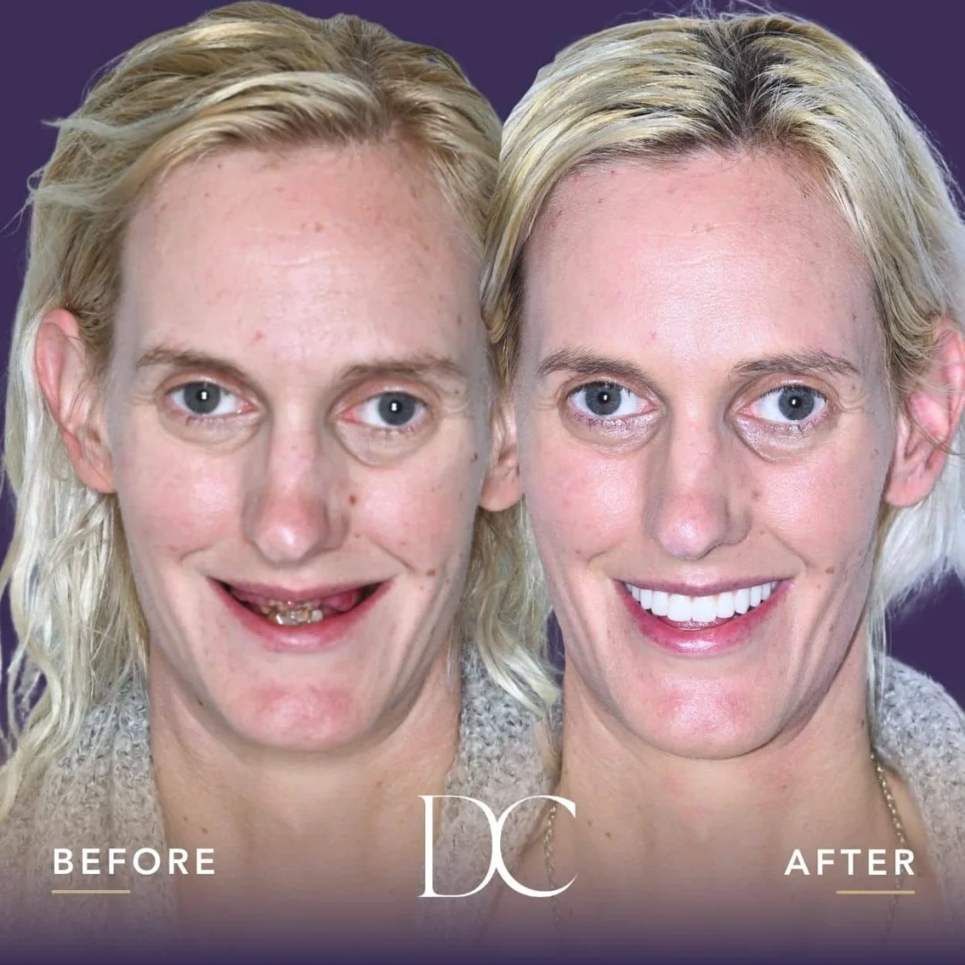 Mary of Sunbury's A04 Smile Journey in Dental Couture