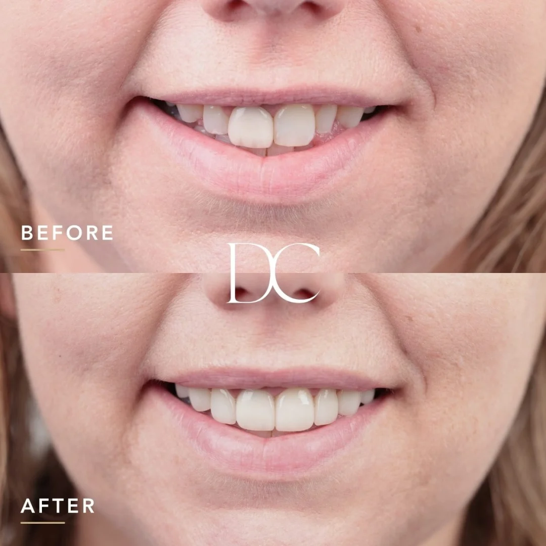 Melissa of Sunbury's Dental Veneers Journey in Dental Couture