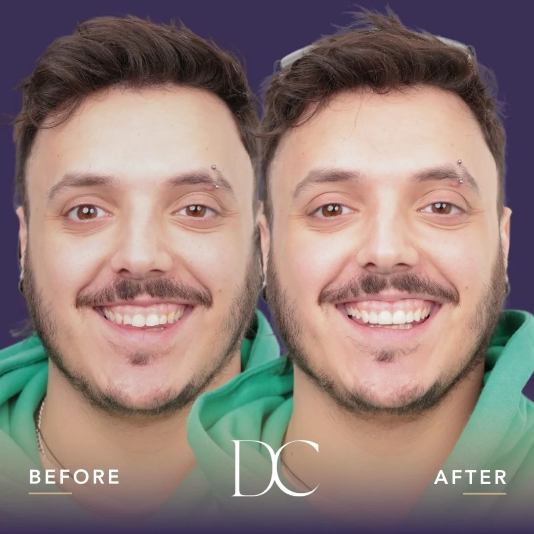 Mike of Melbourne's Composite Bonding Journey in Dental Couture
